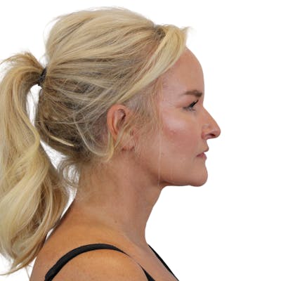 Deep Neck Lift Before & After Gallery - Patient 244405 - Image 8