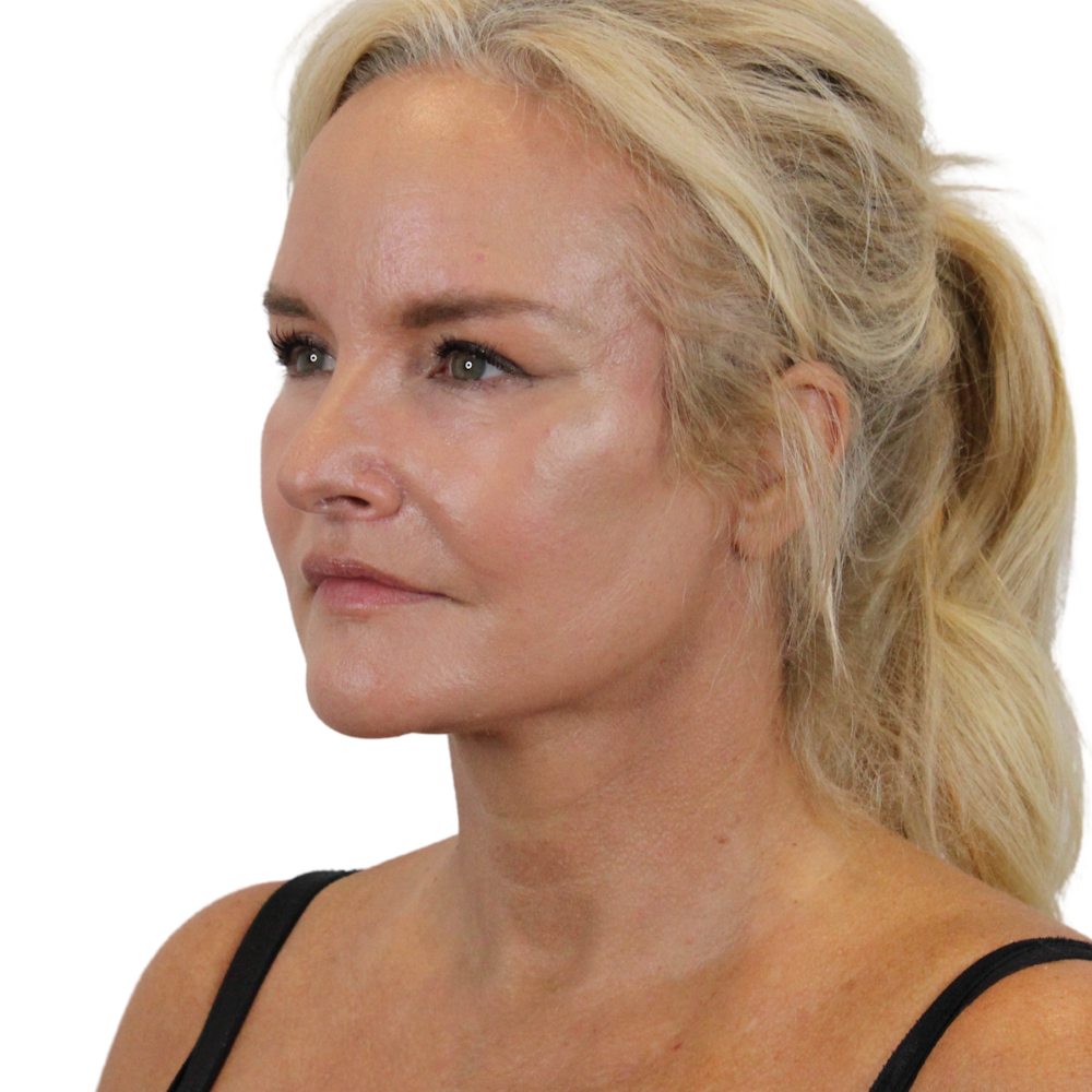 Deep Plane Facelift Before & After Gallery - Patient 541726 - Image 4