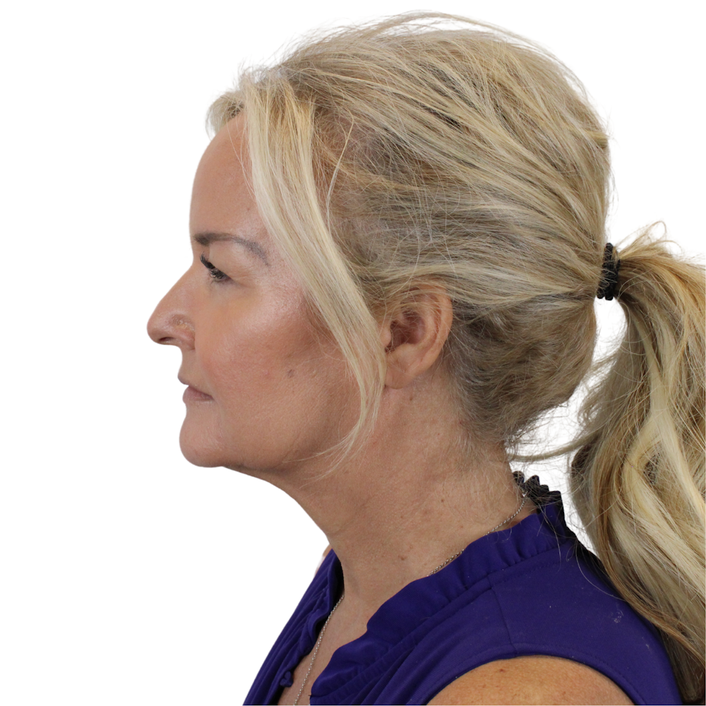 Deep Neck Lift Before & After Gallery - Patient 244405 - Image 5