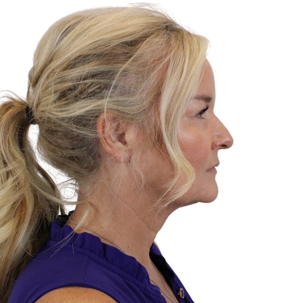 Deep Neck Lift Before & After Gallery - Patient 244405 - Image 7
