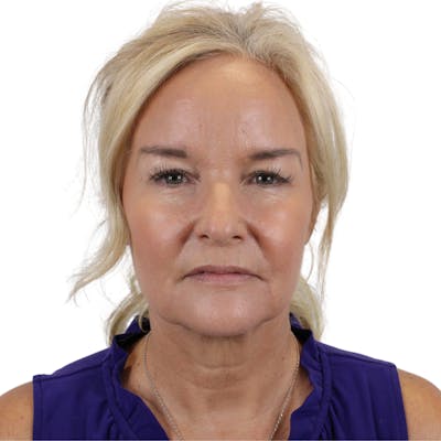 Deep Neck Lift Before & After Gallery - Patient 244405 - Image 1