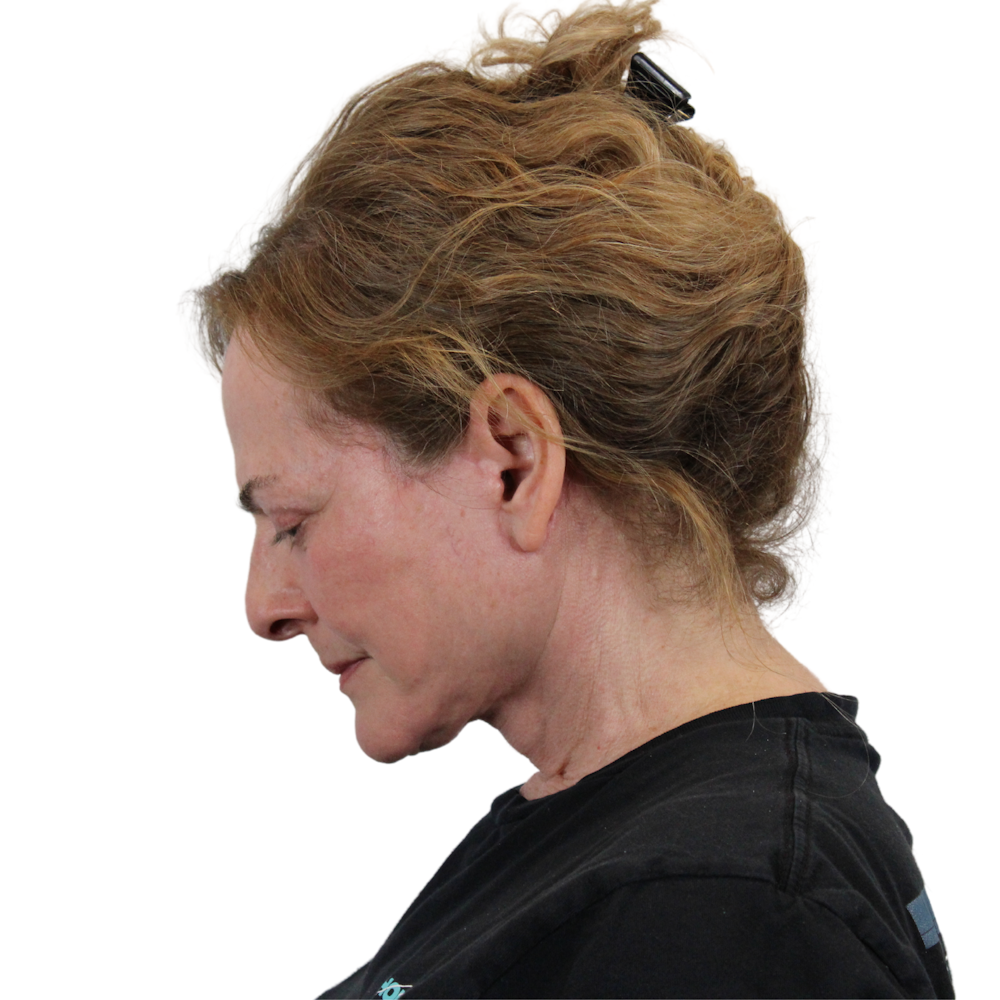 Deep Plane Facelift Before & After Gallery - Patient 224233 - Image 14