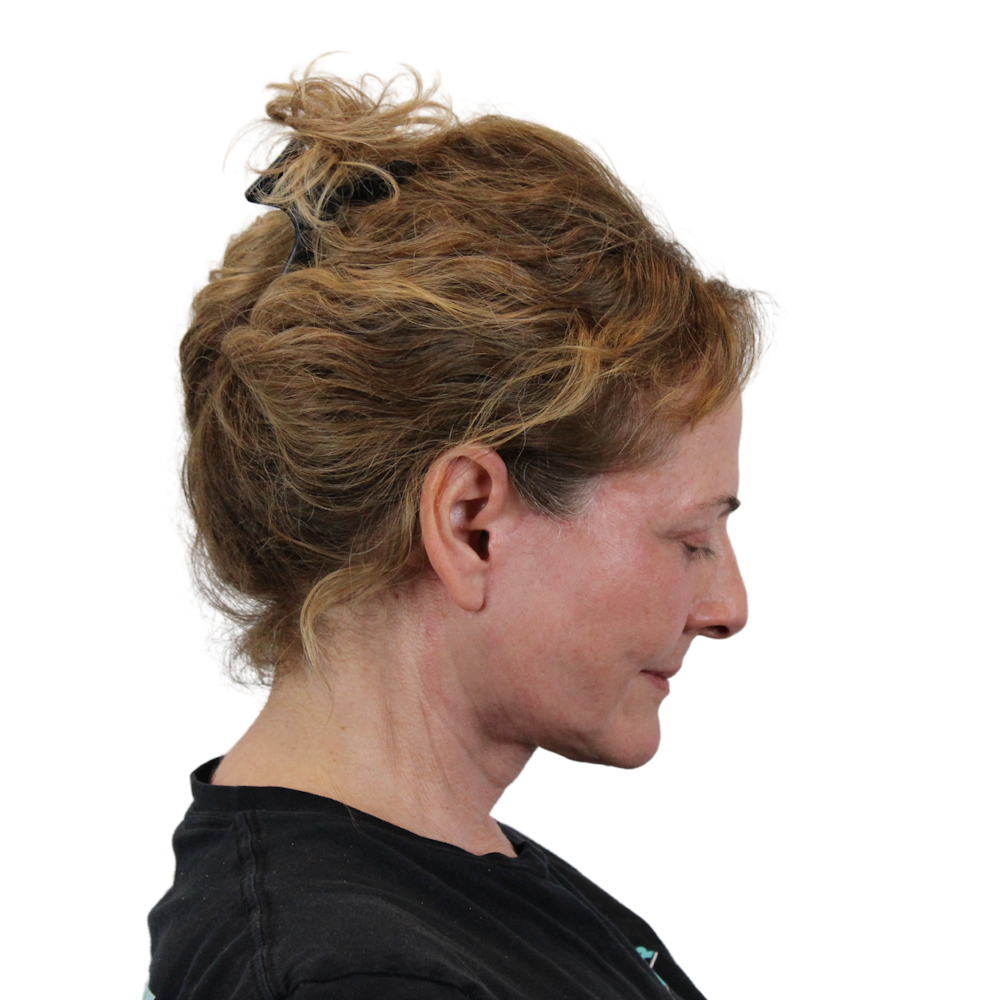 Deep Neck Lift Before & After Gallery - Patient 397563 - Image 8