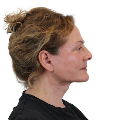 Deep Plane Facelift Before & After Gallery - Patient 224233 - Image 6