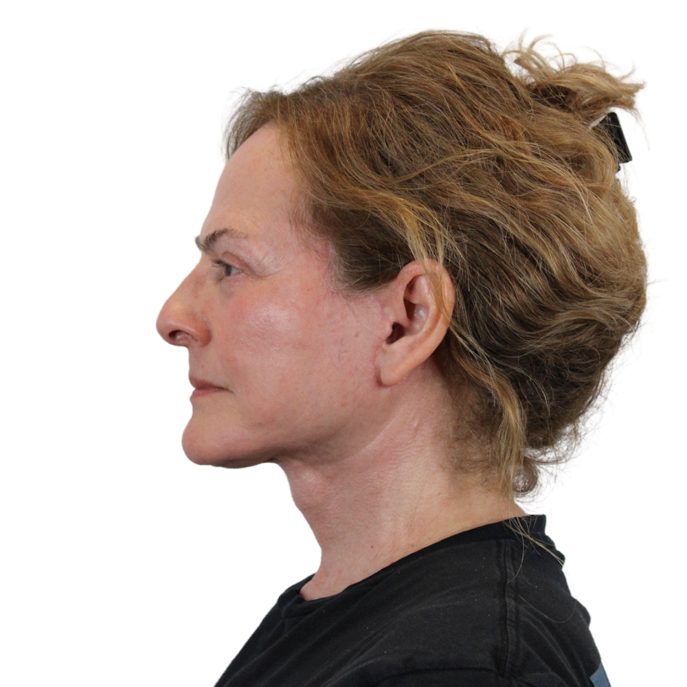Deep Neck Lift Before & After Gallery - Patient 397563 - Image 12