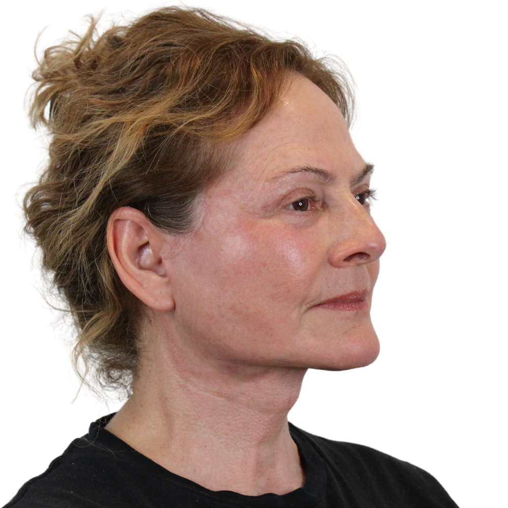 Deep Plane Facelift Before & After Gallery - Patient 224233 - Image 4