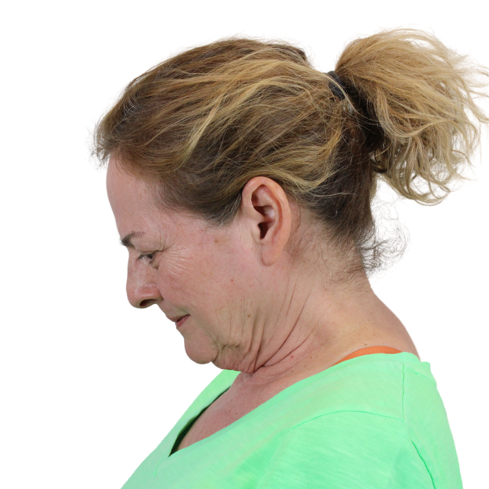 Deep Neck Lift Before & After Gallery - Patient 397563 - Image 13