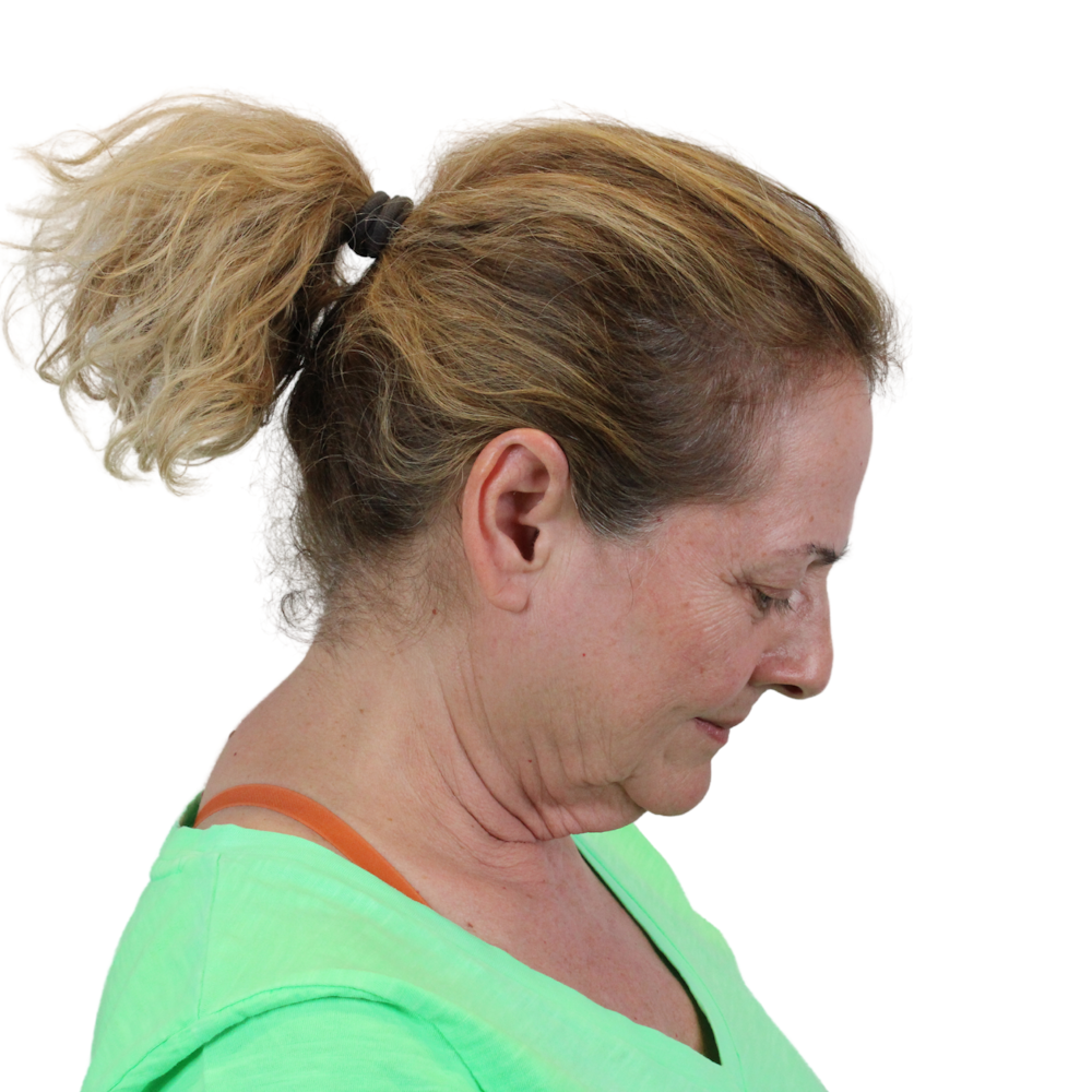 Deep Neck Lift Before & After Gallery - Patient 397563 - Image 7
