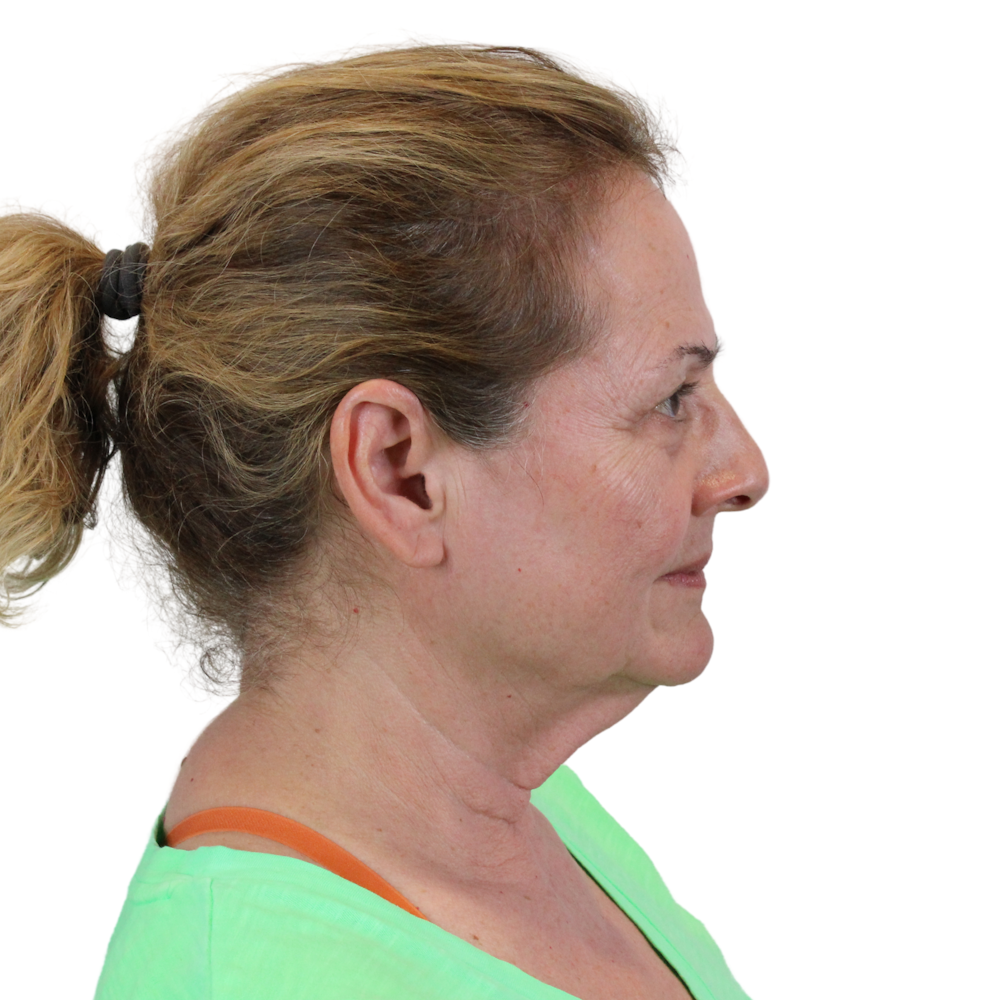 Deep Plane Facelift Before & After Gallery - Patient 224233 - Image 5