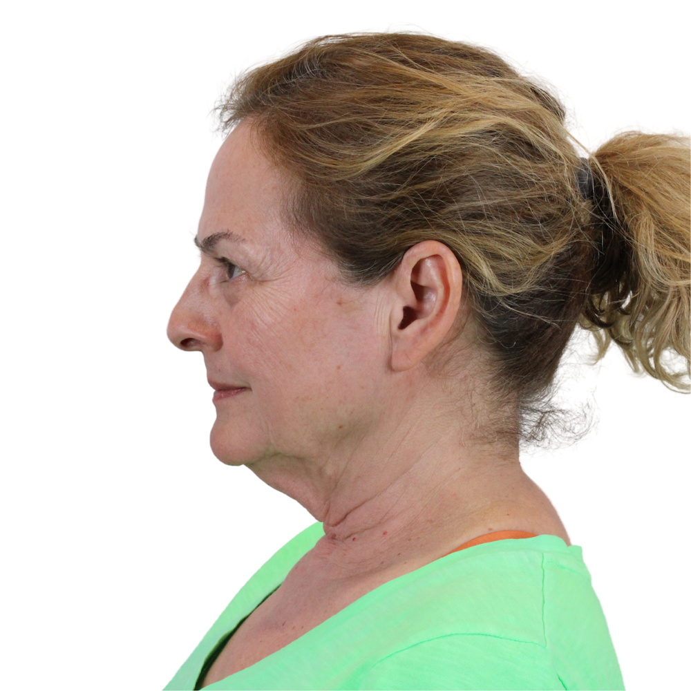 Deep Plane Facelift Before & After Gallery - Patient 224233 - Image 11