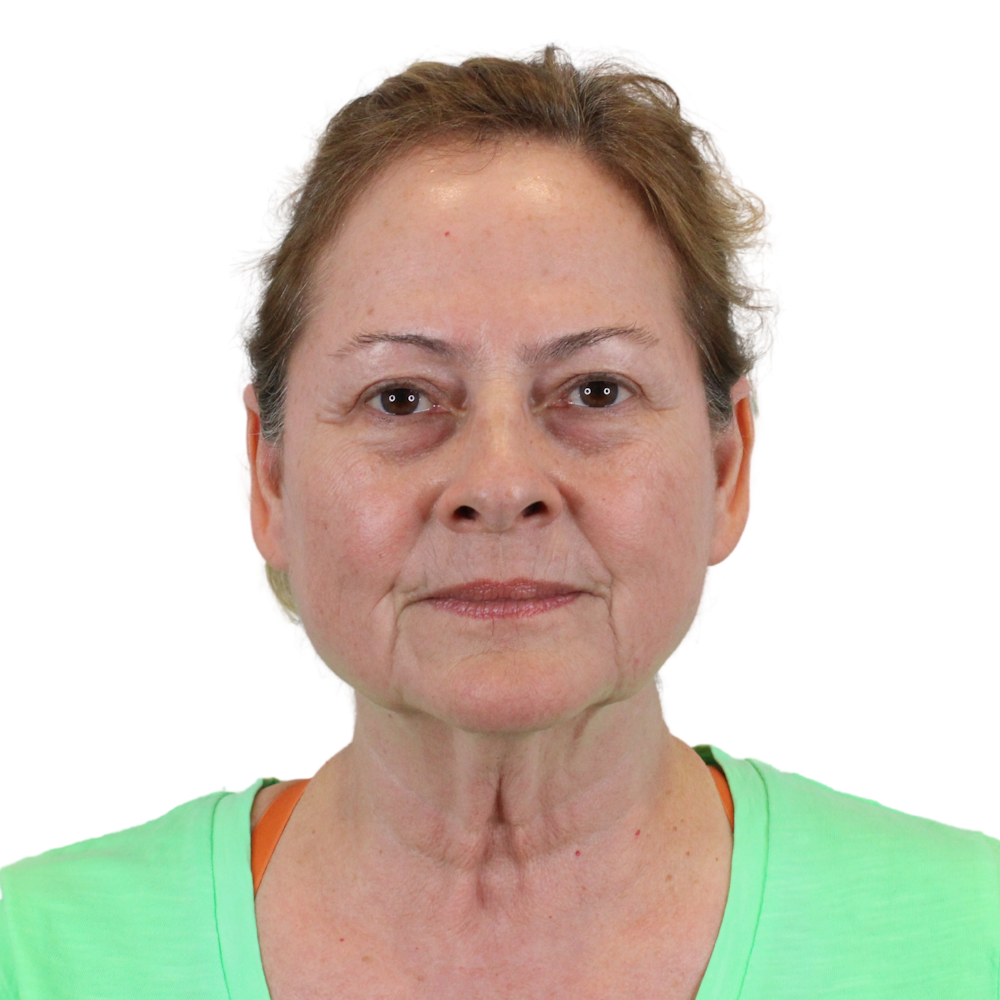 Deep Plane Facelift Before & After Gallery - Patient 224233 - Image 1