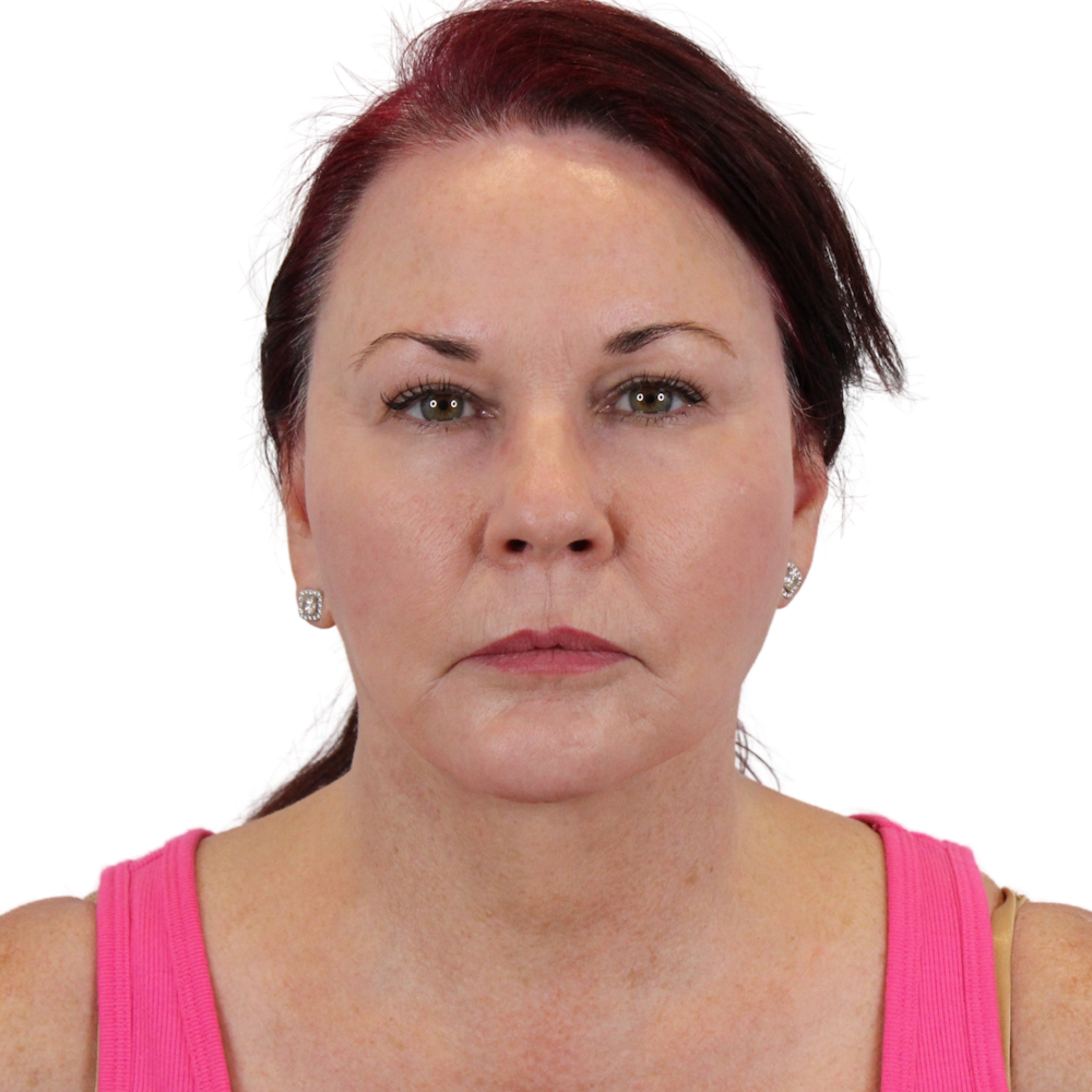 Deep Plane Facelift Before & After Gallery - Patient 876280 - Image 2