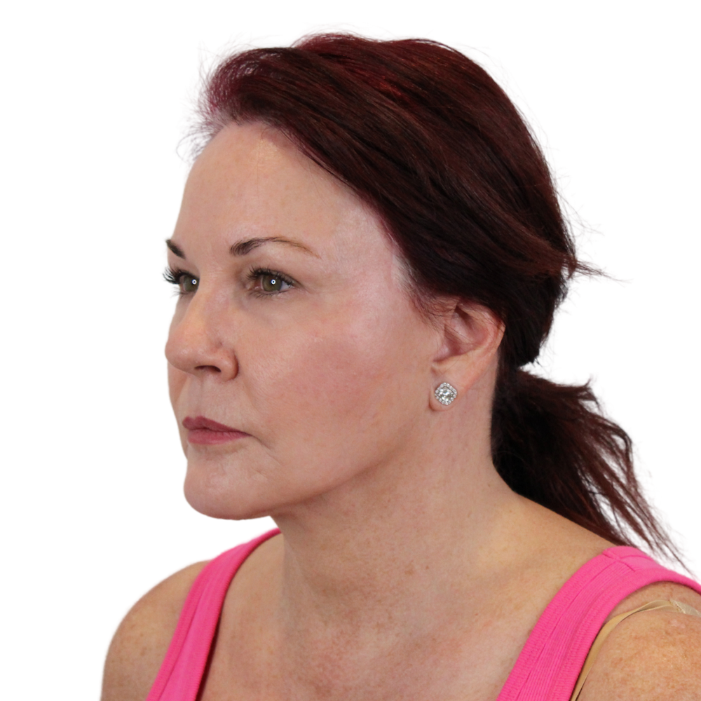 Deep Plane Facelift Before & After Gallery - Patient 876280 - Image 6