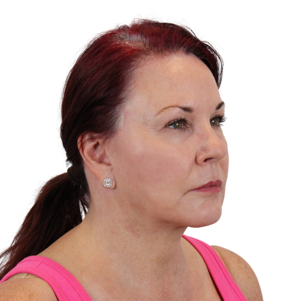 Deep Plane Facelift Before & After Gallery - Patient 876280 - Image 4