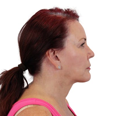 Deep Neck Lift Before & After Gallery - Patient 333180 - Image 8