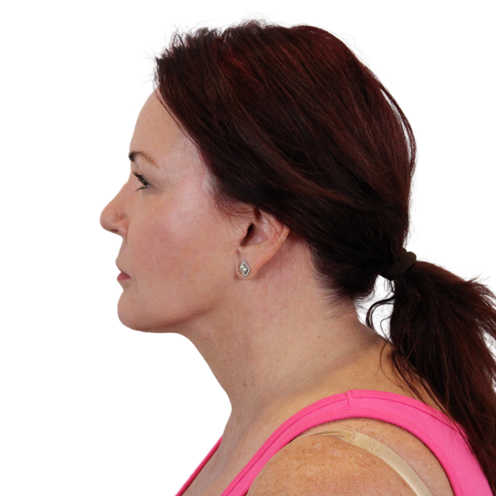 Deep Plane Facelift Before & After Gallery - Patient 876280 - Image 10