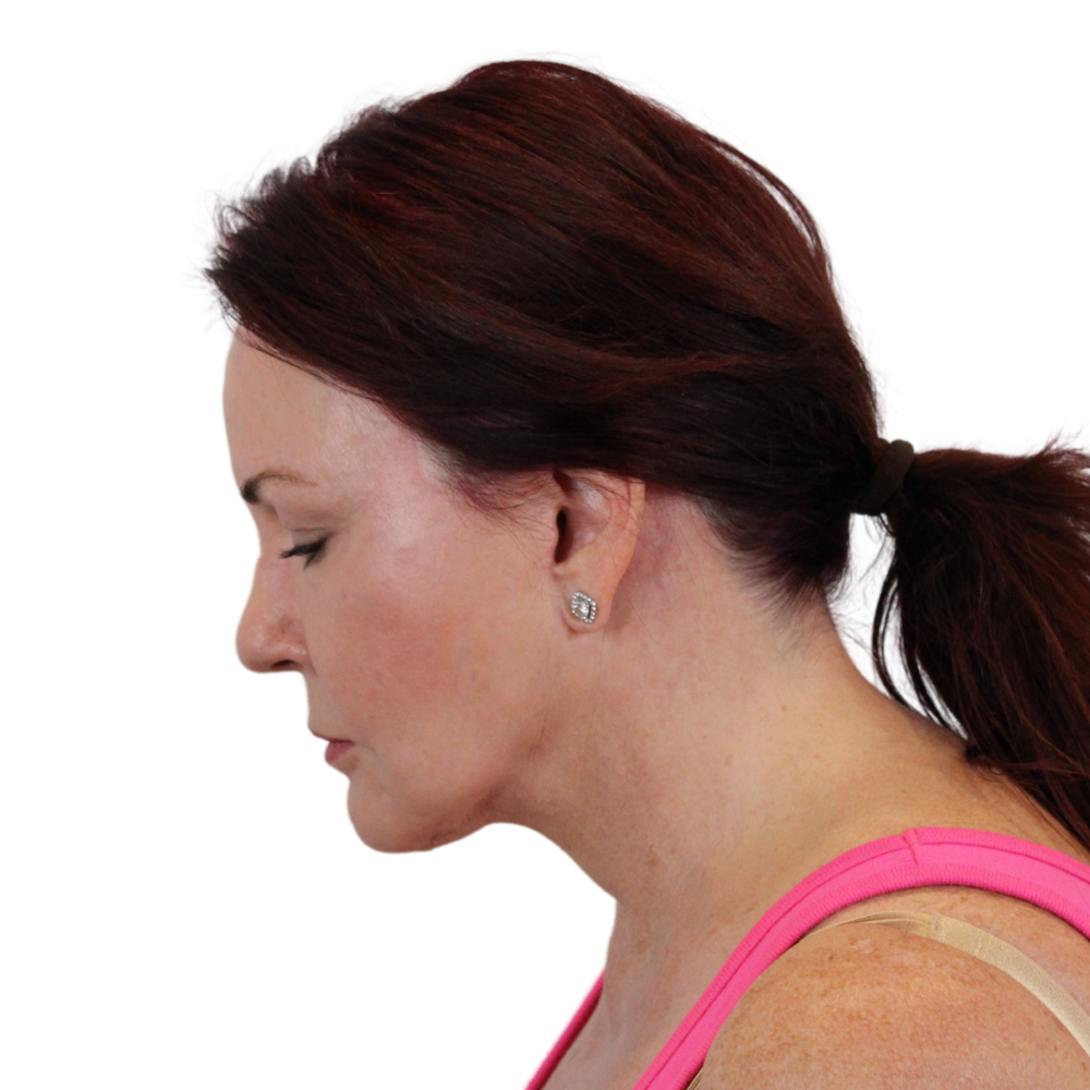 Deep Neck Lift Before & After Gallery - Patient 333180 - Image 12