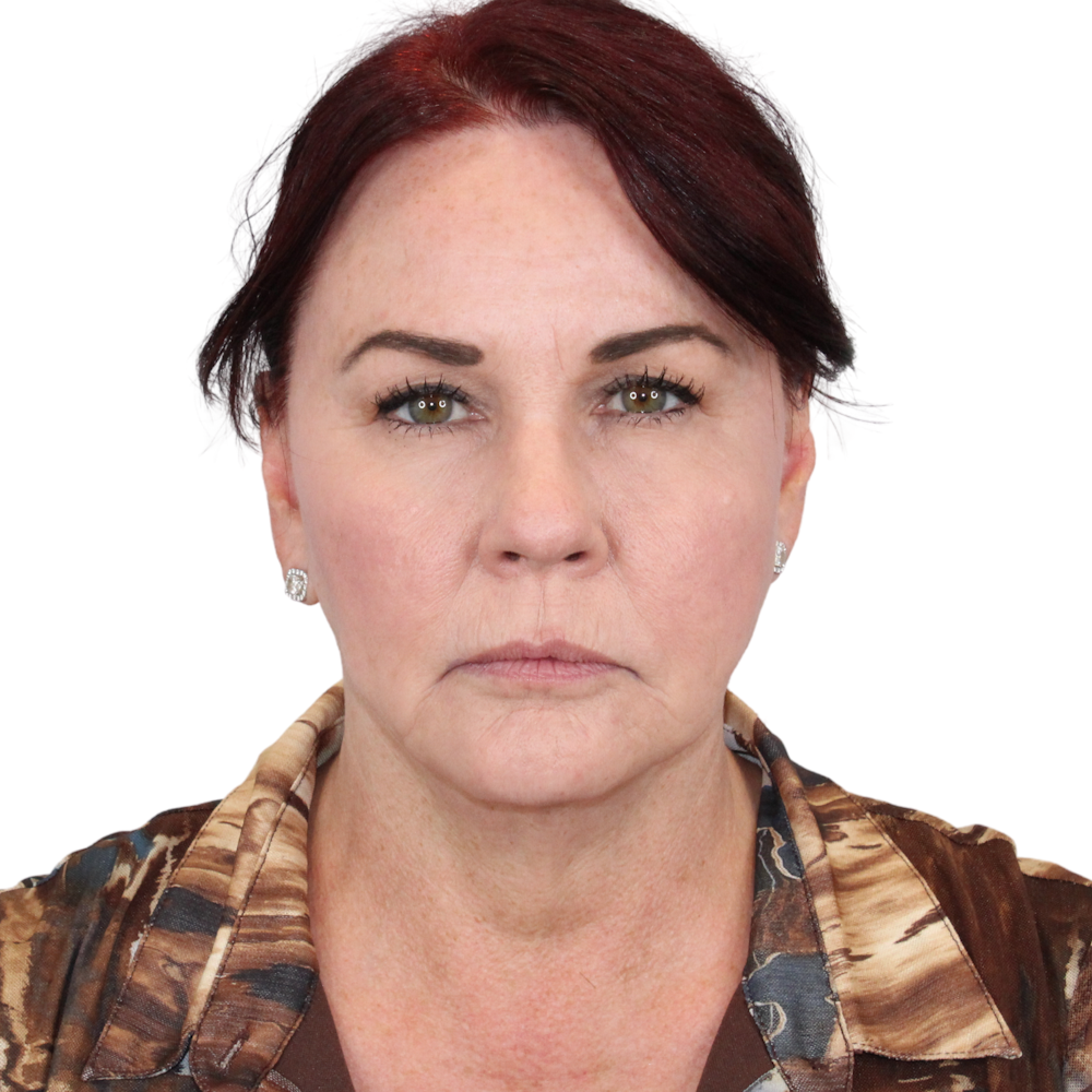 Deep Plane Facelift Before & After Gallery - Patient 876280 - Image 1