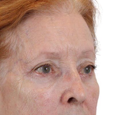 Blepharoplasty Before & After Gallery - Patient 260011 - Image 4