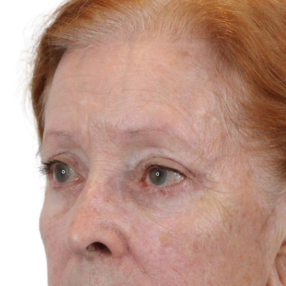 Blepharoplasty Before & After Gallery - Patient 260011 - Image 6