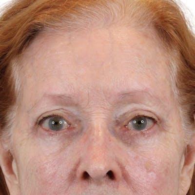 Blepharoplasty Before & After Gallery - Patient 260011 - Image 2