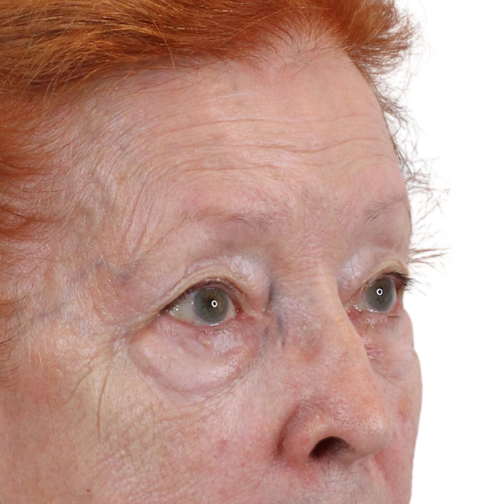 Blepharoplasty Before & After Gallery - Patient 260011 - Image 3
