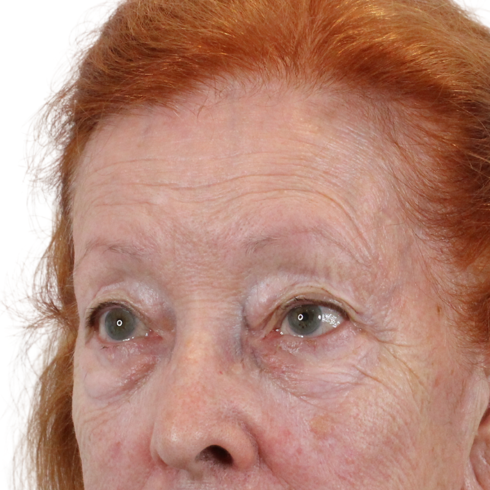Blepharoplasty Before & After Gallery - Patient 260011 - Image 5