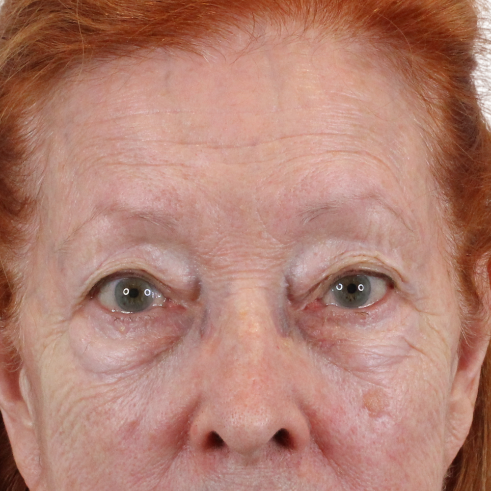 Blepharoplasty Before & After Gallery - Patient 260011 - Image 1