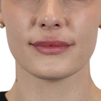 Lip Filler Before & After Gallery - Patient 101946 - Image 2