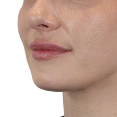 Lip Filler Before & After Gallery - Patient 101946 - Image 6