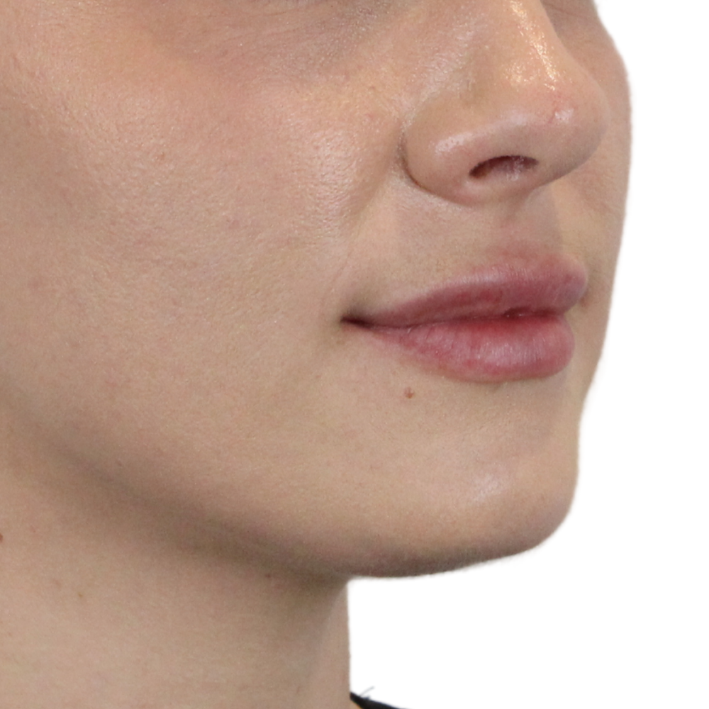 Lip Filler Before & After Gallery - Patient 101946 - Image 4