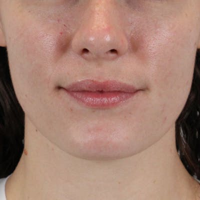 Lip Filler Before & After Gallery - Patient 101946 - Image 1