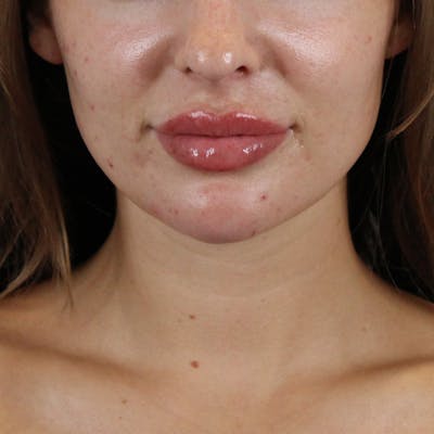 Lip Filler Before & After Gallery - Patient 512815 - Image 2