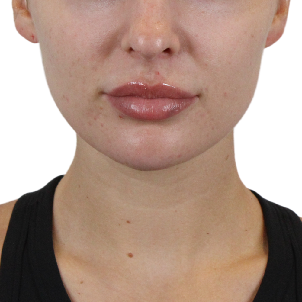 Lip Filler Before & After Gallery - Patient 512815 - Image 1
