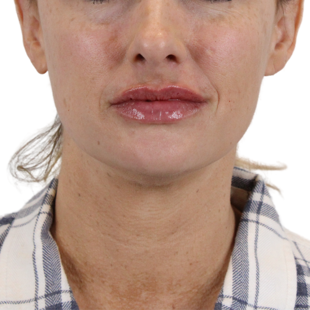 Lip Filler Before & After Gallery - Patient 343132 - Image 2
