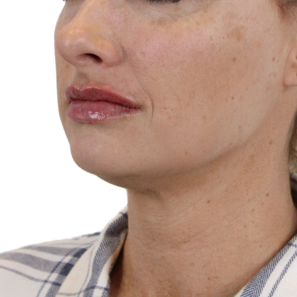 Lip Filler Before & After Gallery - Patient 343132 - Image 6