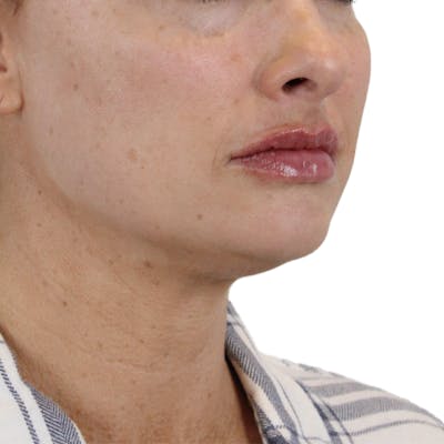 Lip Filler Before & After Gallery - Patient 343132 - Image 4