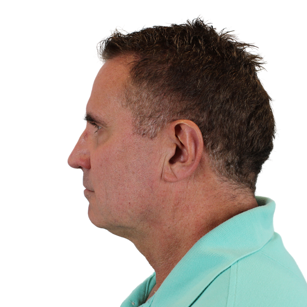 Deep Neck Lift Before & After Gallery - Patient 143555056 - Image 1