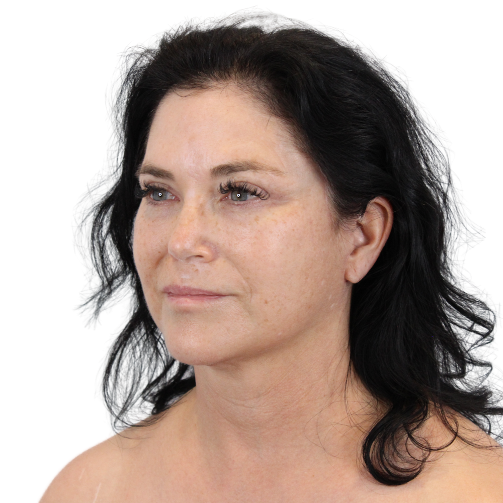 Deep Plane Facelift Before & After Gallery - Patient 269805 - Image 8