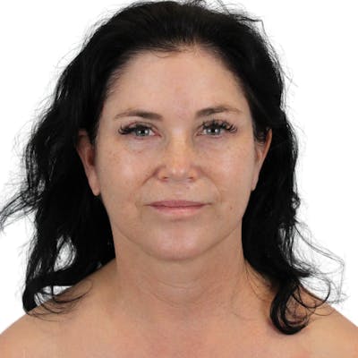 Deep Neck Lift Before & After Gallery - Patient 144451 - Image 2