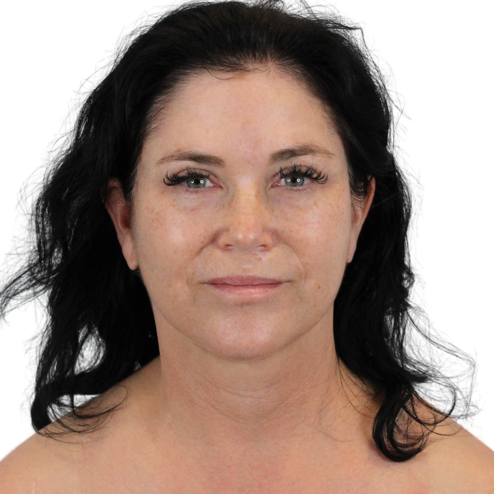 Deep Plane Facelift Before & After Gallery - Patient 269805 - Image 2