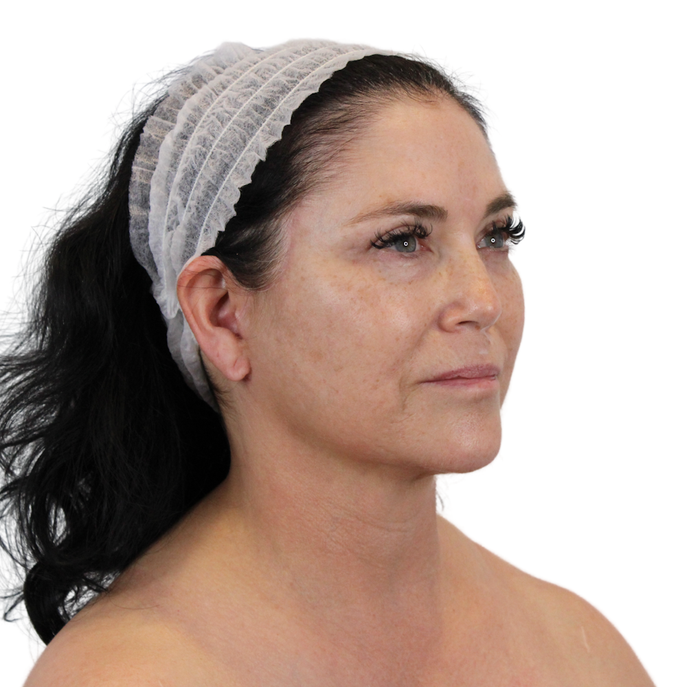 Deep Neck Lift Before & After Gallery - Patient 144451 - Image 4