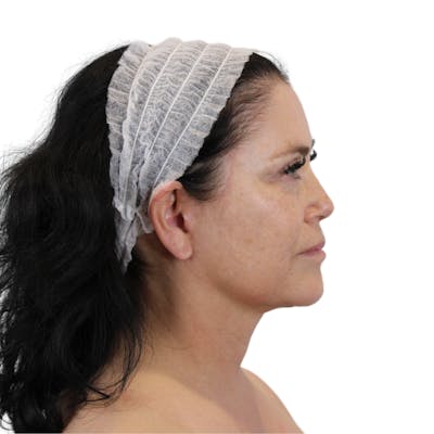 Deep Neck Lift Before & After Gallery - Patient 144451 - Image 6