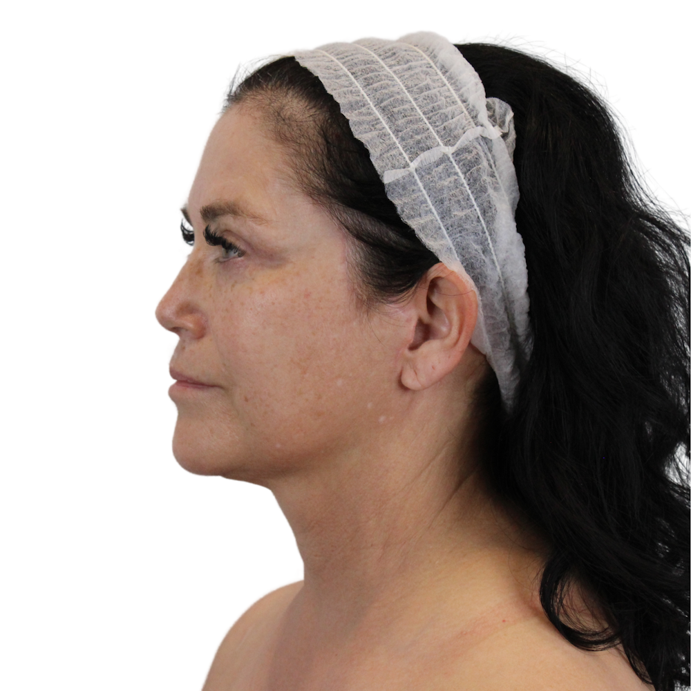 Deep Neck Lift Before & After Gallery - Patient 144451 - Image 10