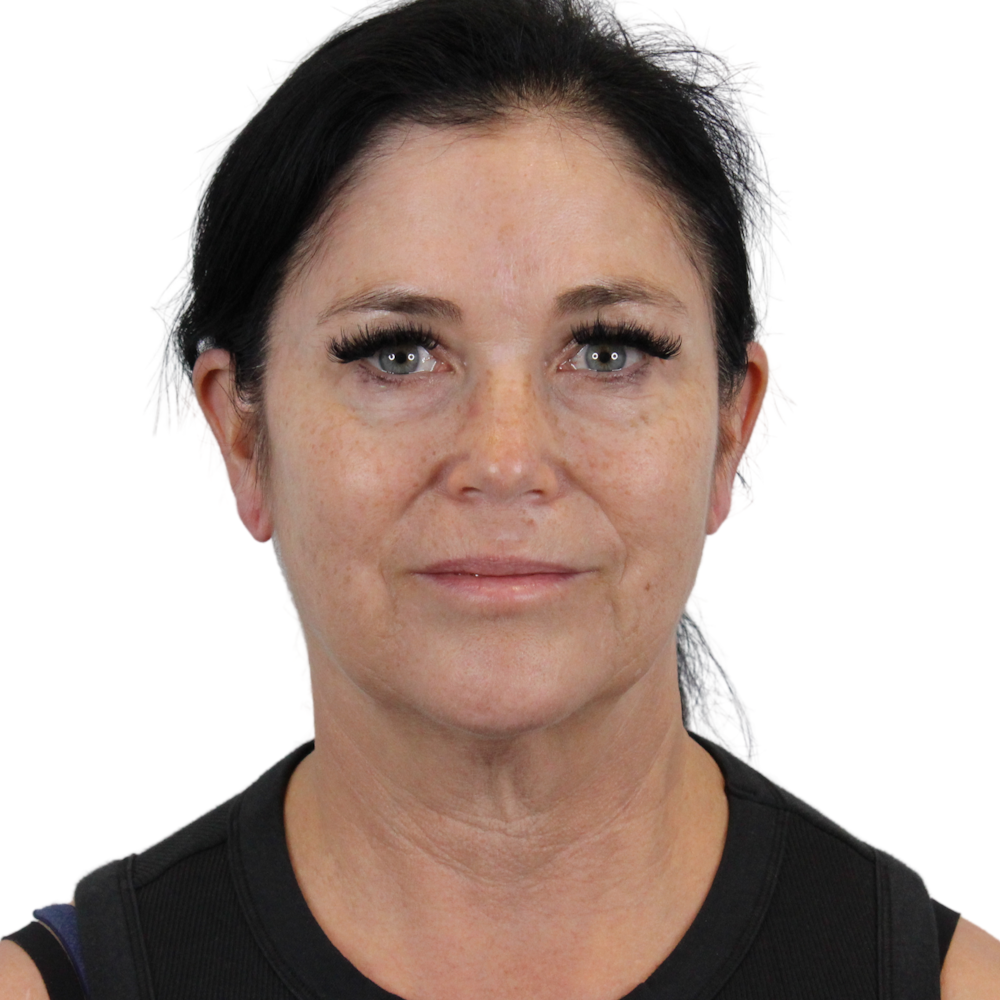 Deep Plane Facelift Before & After Gallery - Patient 269805 - Image 1