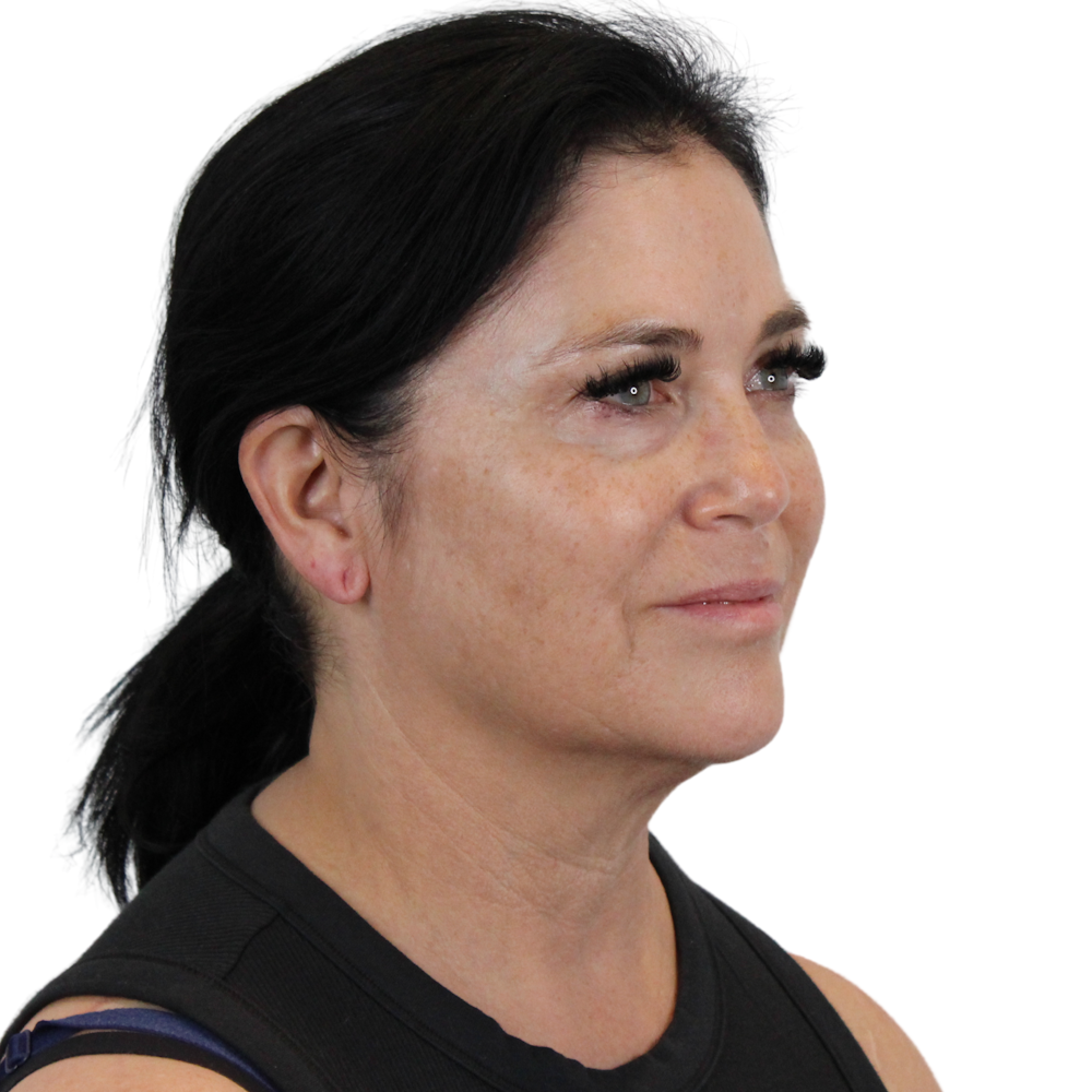 Deep Plane Facelift Before & After Gallery - Patient 269805 - Image 3