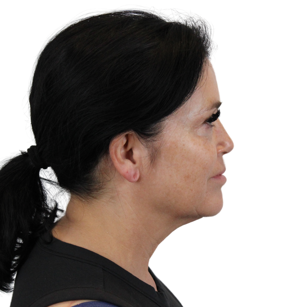 Deep Neck Lift Before & After Gallery - Patient 144451 - Image 5