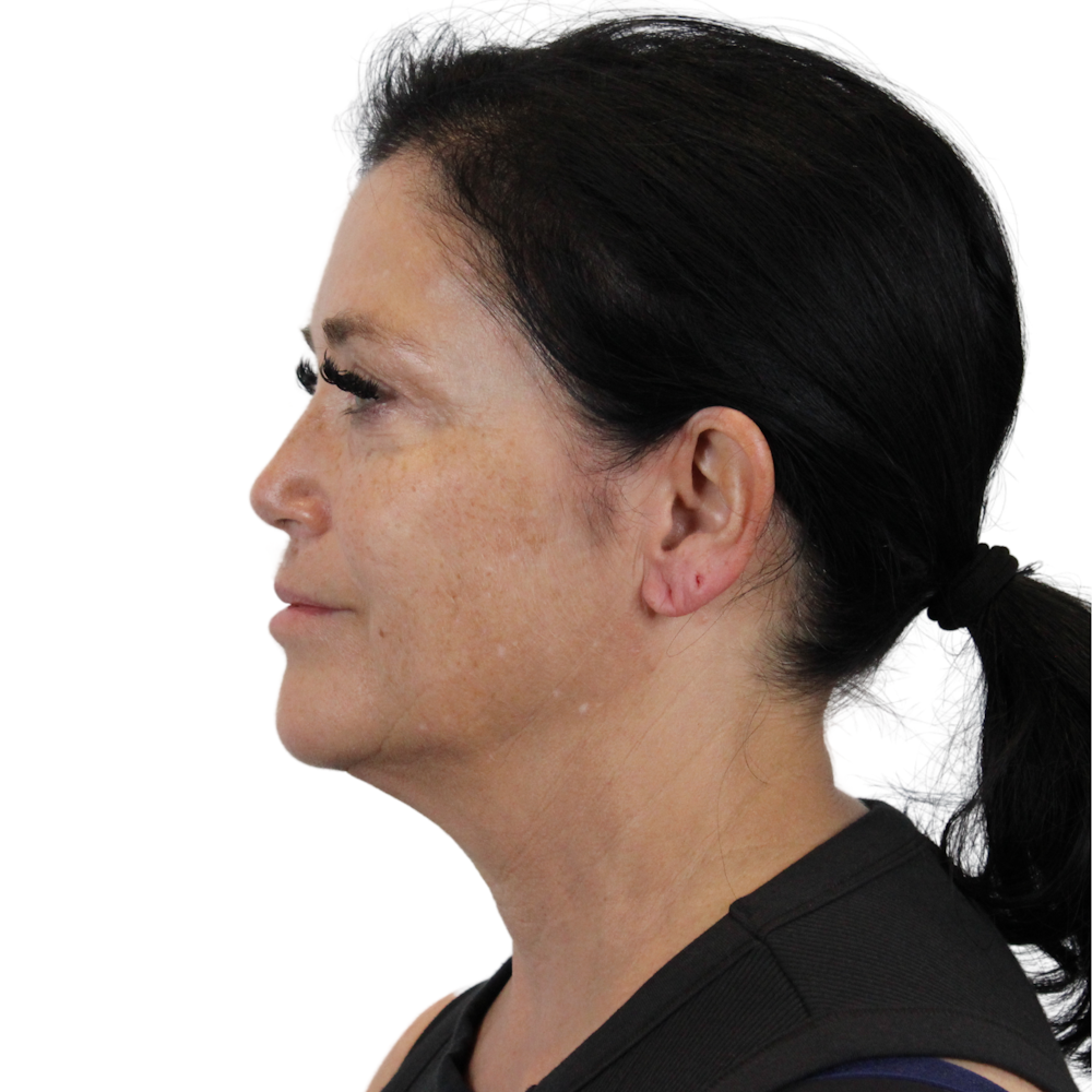 Deep Neck Lift Before & After Gallery - Patient 144451 - Image 9