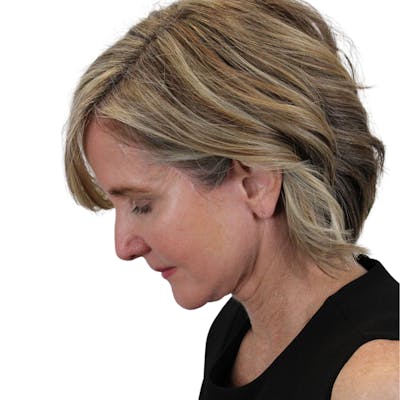Deep Neck Lift Before & After Gallery - Patient 375943 - Image 14