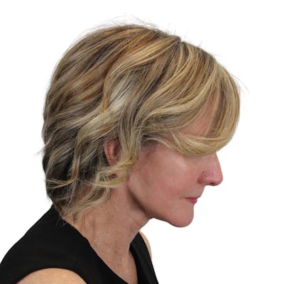 Deep Neck Lift Before & After Gallery - Patient 375943 - Image 8